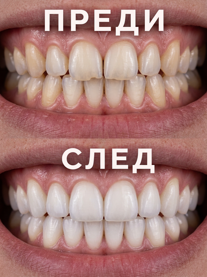 AVORA®-Избелващи лентички за зъби